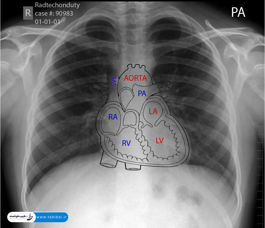 ct-scan-chest-abdomen-pelvis-what-shows-why-prescribed-6