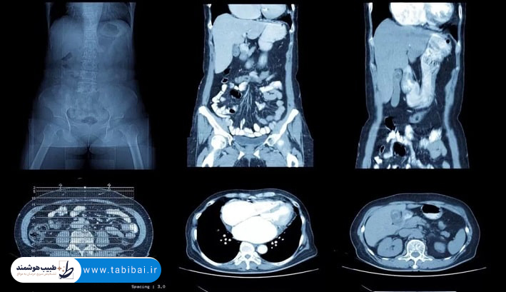 ct-scan-chest-abdomen-pelvis-what-shows-why-prescribed-7
